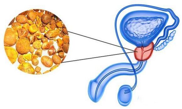 Problems with prostatitis