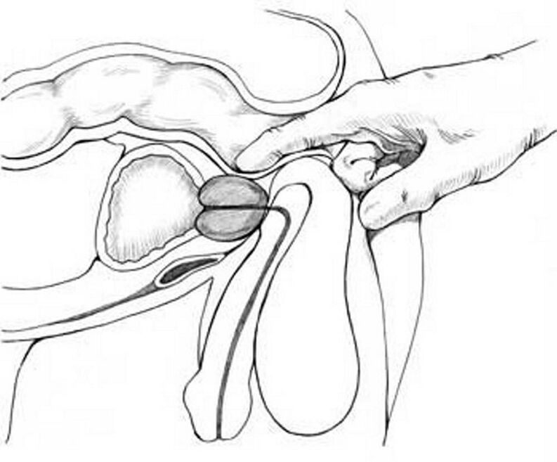 Prostate massage for chronic prostatitis